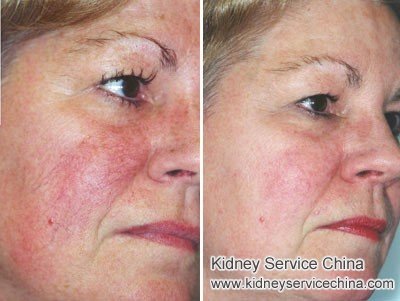 Skin Discoloration for IgA Nephropathy