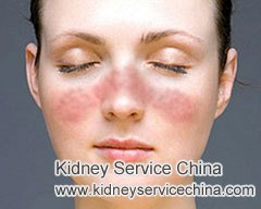 Lupus Nephritis Class 5 with Skin Rash