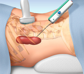 FSGS,kidney biopsy