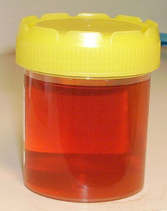 Why Do I Have Bloody or Dark Urine with Chronic Kidney Disease