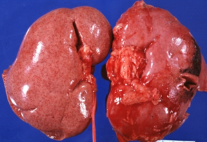 Best Treatment for Lupus Nephritis Stage 4 and Anemia