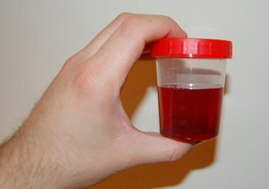 Blood in Urine (Hematuria): A Sign of Kidney Cyst Rupture