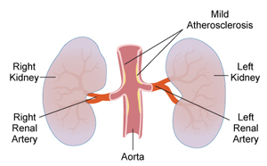 Stage 4 Kidney Failure with One Kidney Shrink Treatment