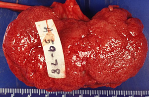 Stage 4 Chronic Kidney Disease with GFR 23 and Creatinine 2.55