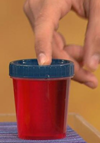 Renal Cysts: Herbal Remedies for Hematuria (Blood in Urine)