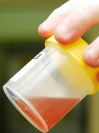 Natural Remedy for Renal Cyst Blood in Urine and Left Loin Pain