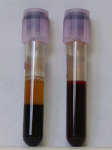 Kidney Failure: BUN 90 and Creatinine 6.9 on Dialysis