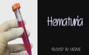Passing Blood in Urine and Pain with Kidney Cyst 7cm