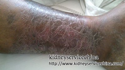 Diabetic Nephropathy: Leg Swelling&Pain Disappear with Herbal Remedy