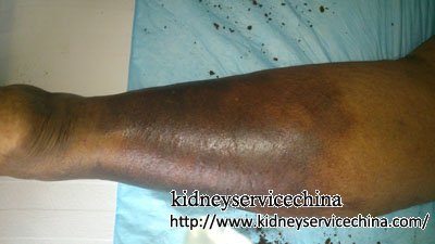 Diabetic Nephropathy: Leg Swelling&Pain Disappear with Herbal Remedy