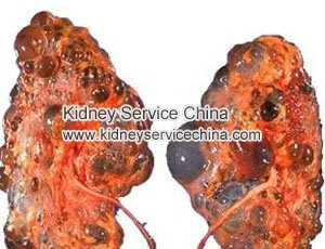 How to Treat PKD and Stage 3 Kidney Disease with Creatinine 3.3