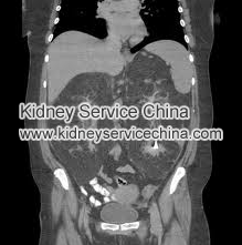 What are the causes of enlarged kidney