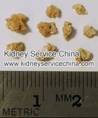 Can Kidney Stone Cause Creatinine Level To Rise