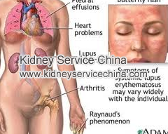 Symptoms Of Patients With Lupus Nephritis