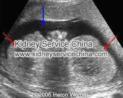 Enlarged Kidney Symptoms