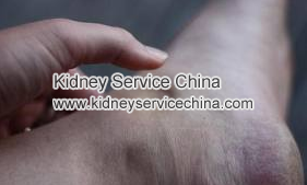 How to treat renal disease patients’ edema