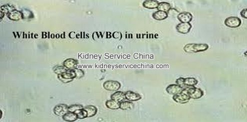 Hypertensive Nephropathy Causes A High Level Of White Blood Cell In Urine
