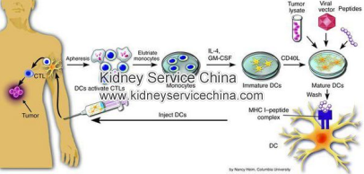 Is there any treatment effective in treating lupus nephritis?  Lupus nephritis is caused by systemic lupus erythematosus (SLE), which is an autoimmune disease. In fact, immunotherapy is a good choice to treat lupus nephritis.  How does patient get lupus nephritis?  For patient who has SLE, he will have many antibodies towards himself, and that will attack his body. When the immune complexes accumulate in patient’s body tissues and organs, that can cause these systems’ damage. While when the immune complexes accumulating in patient’s kidney, it will cause lupus nephritis.  Why immunotherapy can treat lupus nephritis?  Almost all Kidney diseases’ appearance has close relationship with patient’s immune system, and Immunotherapy treating patient’s kidney disease starts from patient’s immune system.  Immunotherapy is divided into six steps, and they are immunodiagnosis, immune elimination, immune blocking, immune tolerance, immune regulation, immune protection. Each step of immunotherapy has its own purpose, and can also reach its effect.  In immunodiagnosis, some conditions of patient will be made clear, like the damage degree in patient’s kidney, the reaction type, the underlying risk factors, etc.  In immune elimination, the toxins and morbid materiel in patient’s blood will be cleared out.  In immune blocking, the cause of patient’s immune disorder will be controlled, which can stop the aggravation of patient’s condition from its root.  In immune tolerance, the damaged kidney cells and foreign materials still exist in patient’s kidney, which will cause inflammatory reaction continuously. So this step is to make patient’s kidney can adapt to the circumstance of living with these foreign materials, and stop the appearance of inflammatory reaction.  In immune regulation, Chinese medicines which aims at eliminating the immune complexes in kidney will be added, and patient’s immunity will be improved to repairing patient’s kidney function.  In immune protection, patient’s immunity is improved to protect patient’s damaged kidney cells and tissues, which can help the recovery of patient’s kidney function.  In the end, if you have trouble in dealing with lupus nephritis, you can just leave us your question, and we will give you detailed answer timely. 