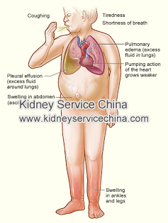 Why Patient With Lupus Nephritis Often Has Severe Edema  