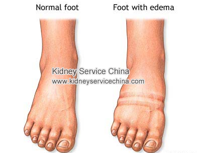 Why Patient With Lupus Nephritis Often Has Obvious Swelling 