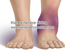 How To Treat Swelling In Lupus Nephritis Efficiently  