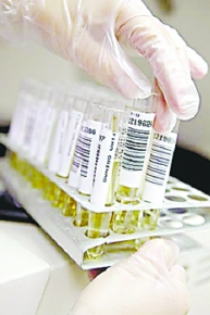 What Does Foamy Urine Indicate In Patient With Lupus Nephritis