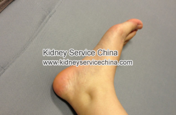 Why Patient With Lupus Nephritis Often Has Ankle Swelling  