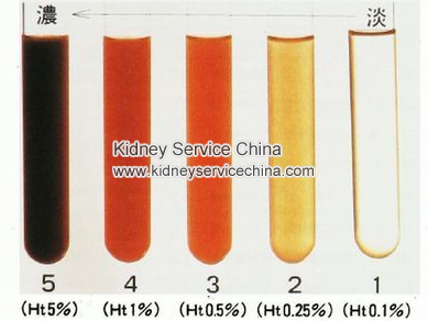 Why Patient With Lupus Nephritis Has Hematuria