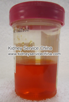 How To Treat Hematuria In Patient With Lupus Nephritis