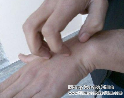 How To Treat Itching In Patient With Lupus Nephrit