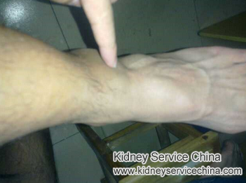 How To Treat Edema In Patients With FSGS