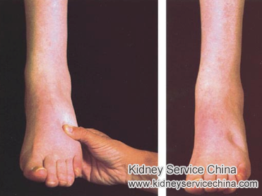 How To Relieve Swelling In FSGS