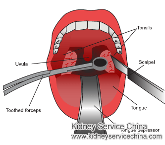 Is Tonsillectomy Necessary for IgA Nephropathy Patient