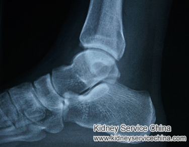 How to deal with gout in ankles with FSGS?