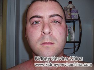 How to Treat Swollen Face And Proteinuria in IgA Nephropathy