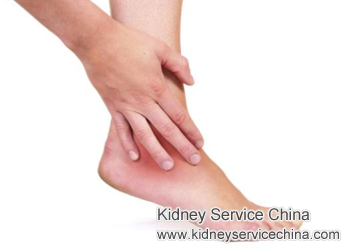 Lupus Nephritis and Swelling of Legs: Causes and Treatment