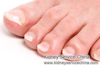 Treatment to Swelling in Left Foot for Diabetic Nephropathy