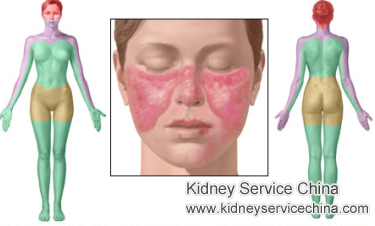 Why Do Lupus Nephritis Patients Have Mouth Ulcers