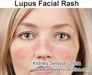 How to Treat Lupus Face Rash