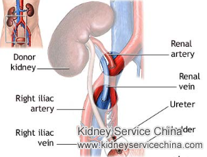 Would IgA Nephropathy Attack New Kidney After Kidney Transplant
