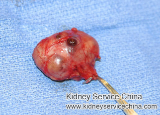 Should I Worry About My 4.8 cm and 3.8 cm Renal Cortical Cysts