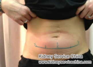 Best Treatment for Stage 3 Lupus with Swelling in Belly