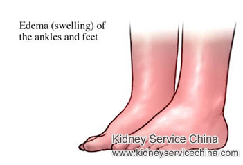Swelling in Lower Leg, Feet and Ankles for Lupus