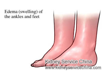 How Do You Stop Swelling All Over With FSGS