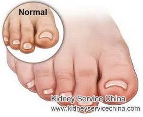 Methods to Alleviate Extreme Edema In Feet for FSGS Patients