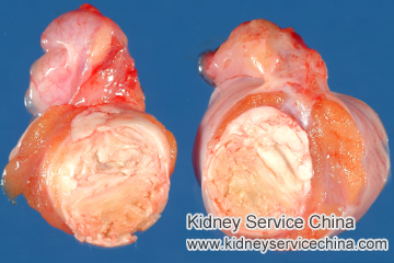 Renal Cortical Cyst and Dermoid Cyst: Is There Medication to Avoid Surgery