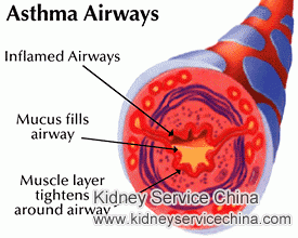 Is There Any Link Between Asthma and Nephrotic Syndrome