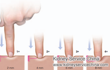 Lower Limb Edema and Proteinuria 4+ for Lupus Nephritis