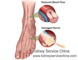 Foot Neuropathy for Diabetic Nephropathy Patients