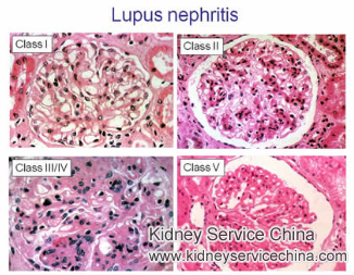 Learn More About Stage 5 Lupus Nephritis